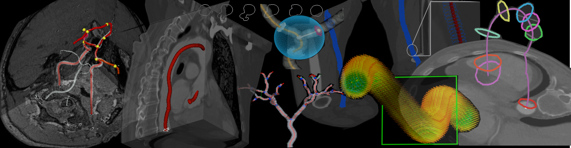 Detection and Extraction of Vascular Networks using Hough Transform